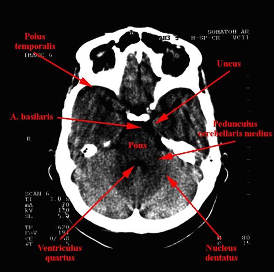 tomografia komputerowa głowy - 05c.jpg